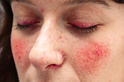 Rosacea-Treatment-in-North-Central-Phoenix-AZ